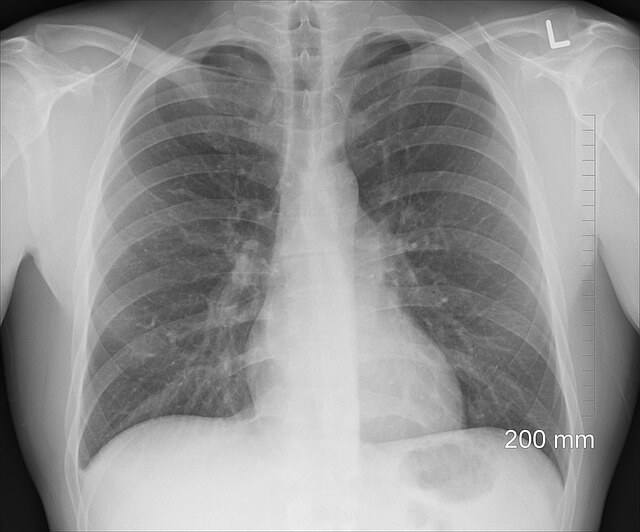 Seguro de salud y el riesgo cardiovascular